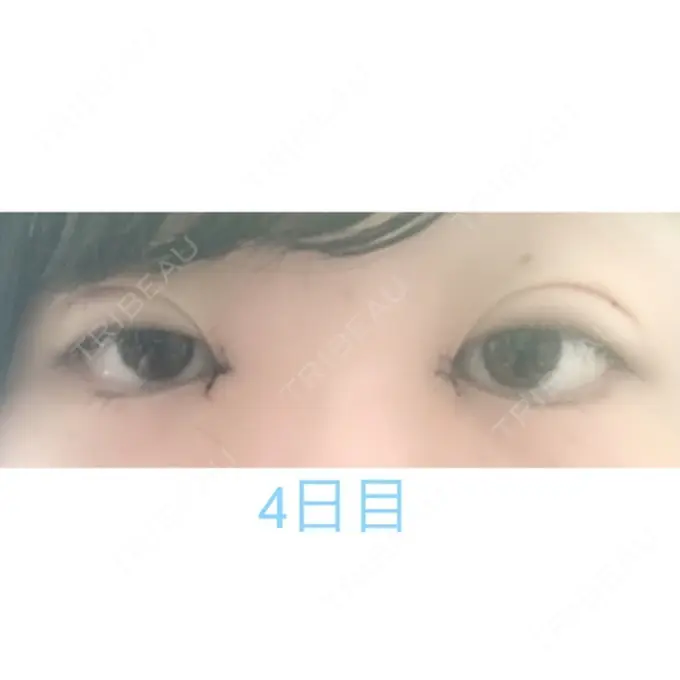 二重埋没 / 目頭切開 湘南美容クリニック 長野院 DAY 4 メイン用