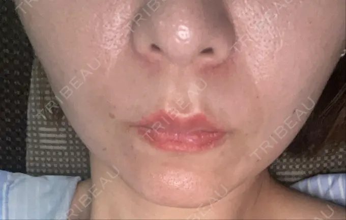 糸リフト 東京シンデレラ美容外科 新宿院 DAY 1 メイン用