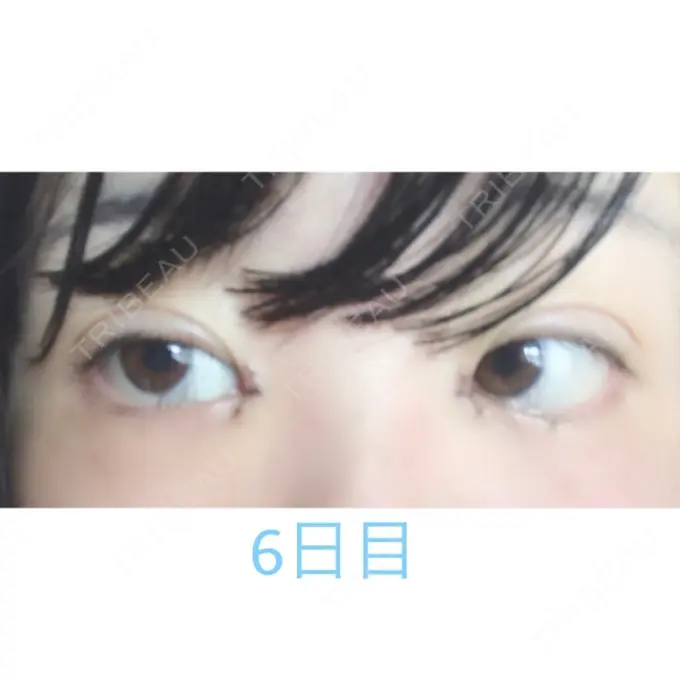 二重埋没 / 目頭切開 湘南美容クリニック 長野院 DAY 6 メイン用