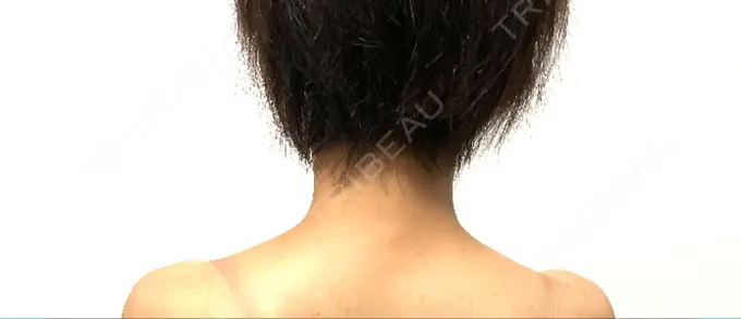 ボトックス（肩） TCB東京中央美容外科 京都駅前院 DAY 1 メイン用