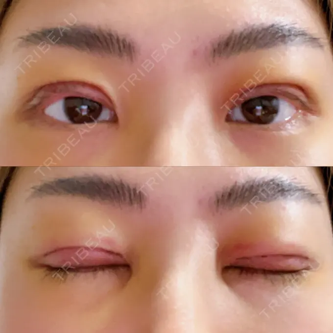 二重切開 みずほクリニック DAY 4 メイン用