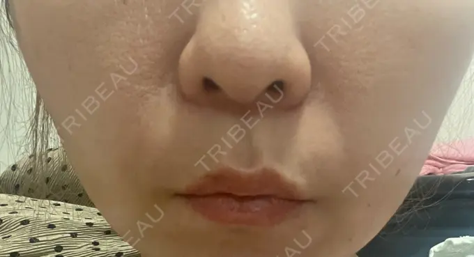 糸リフト 東京シンデレラ美容外科 新宿院 DAY 2 メイン用