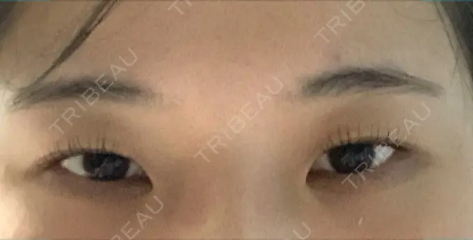 クマ治療 表参道ウィズ・クリニック DAY 13 メイン用