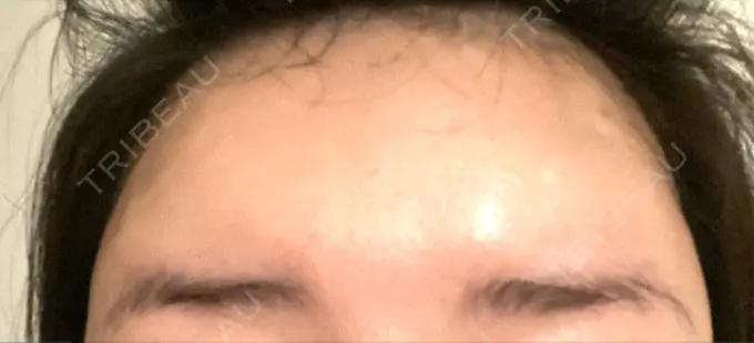 ボトックス（額） 東京美容医療クリニック 池袋院 AFTER メイン用