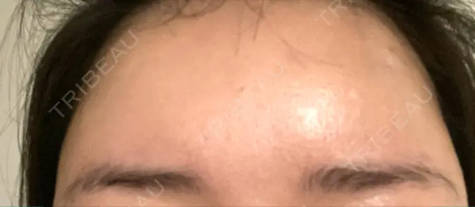 ボトックス（額） 東京美容医療クリニック 池袋院 DAY 10 メイン用