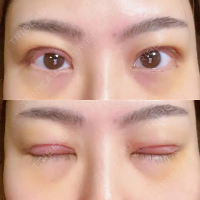 二重切開 みずほクリニック DAY 5 メイン用