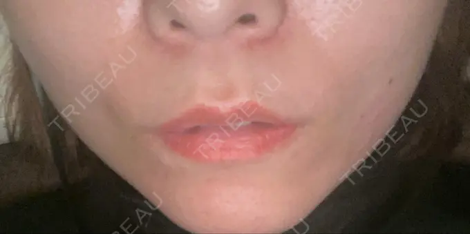 糸リフト 東京シンデレラ美容外科 新宿院 DAY 3 メイン用