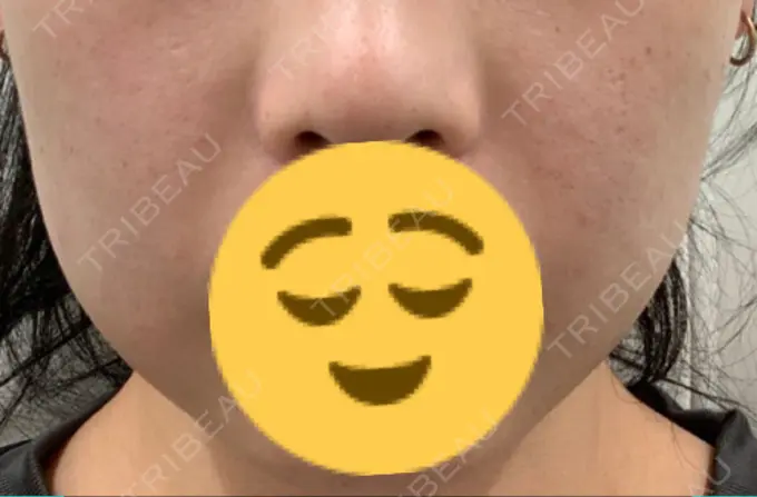 バッカルファット除去 Otus Clinic 【オータスクリニック】 DAY 6 メイン用