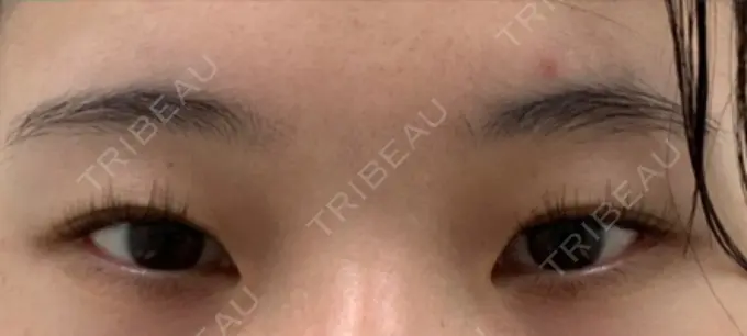 クマ治療 表参道ウィズ・クリニック AFTER メイン用