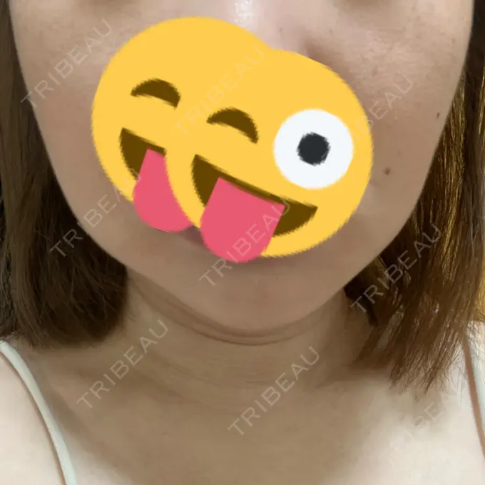 脂肪溶解注射（顔） 表参道ウィズ・クリニック DAY 0 メイン用