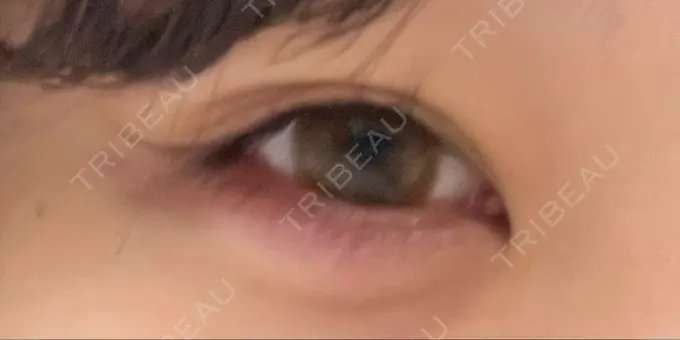 ヒアルロン酸注入（涙袋） HAAB BEAUTY CLINIC 横浜院 AFTER メイン用