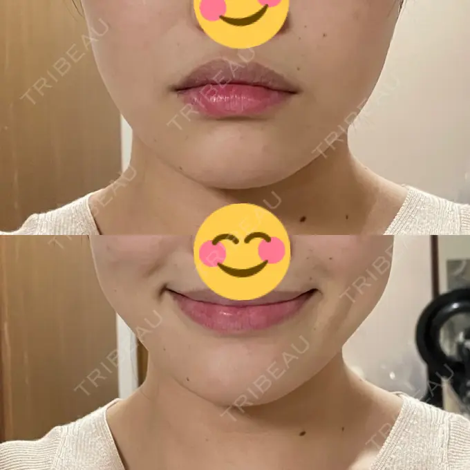 ボトックス（エラ・小顔） 日比谷セントラルクリニック DAY 15 メイン用