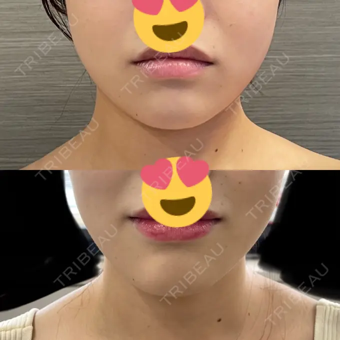 ボトックス（エラ・小顔） 日比谷セントラルクリニック DAY 18 メイン用