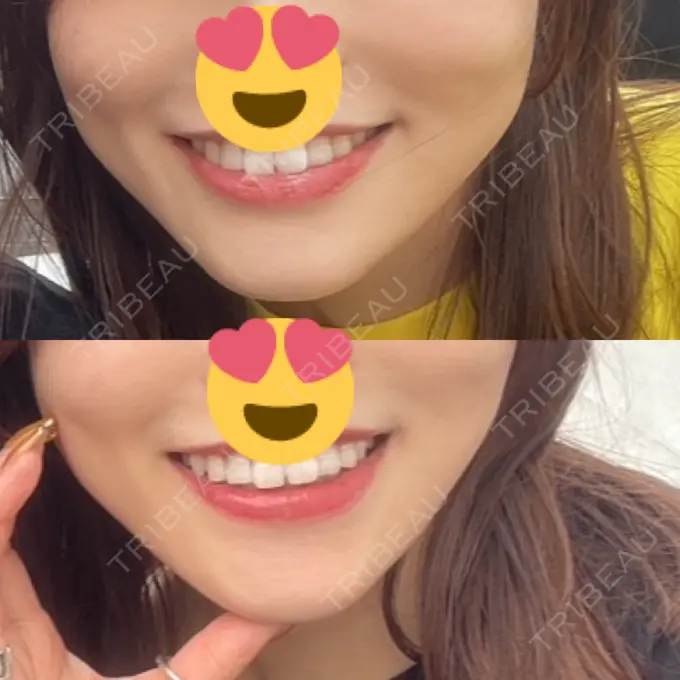 ボトックス（エラ・小顔） 日比谷セントラルクリニック DAY 28 メイン用