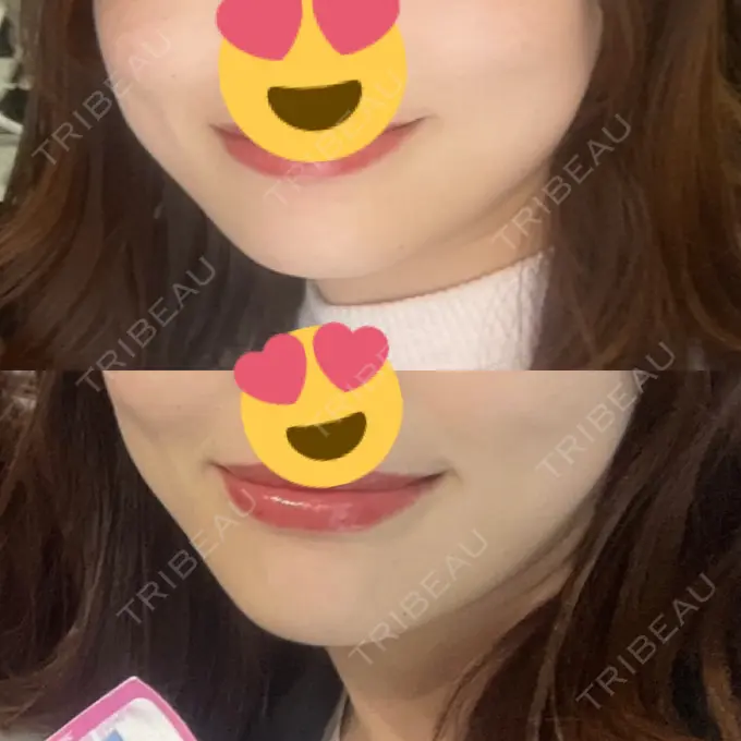 ボトックス（エラ・小顔） 日比谷セントラルクリニック DAY 38 メイン用