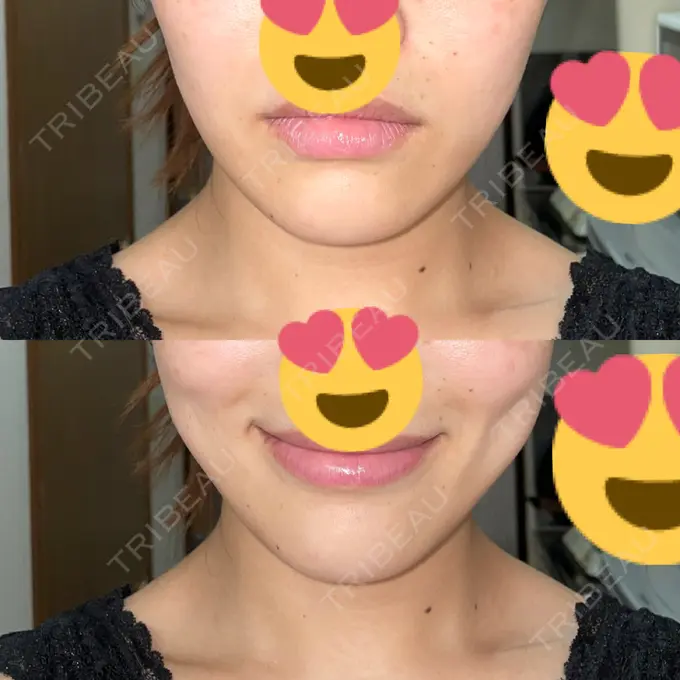 ボトックス（エラ・小顔） 日比谷セントラルクリニック AFTER メイン用