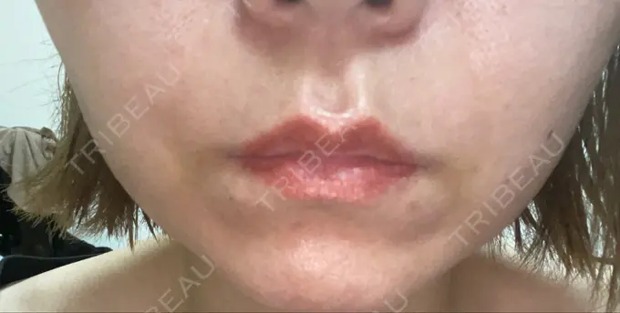 糸リフト 東京シンデレラ美容外科 新宿院 DAY 4 メイン用