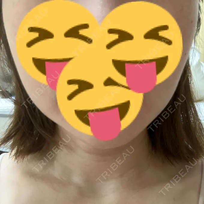 脂肪溶解注射（顔） 表参道ウィズ・クリニック DAY 1 メイン用