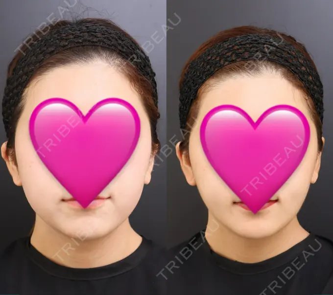 脂肪吸引（顔） / ジョールファット除去 / ボトックス（エラ・小顔） Otus Clinic 【オータスクリニック】 DAY 185 メイン用