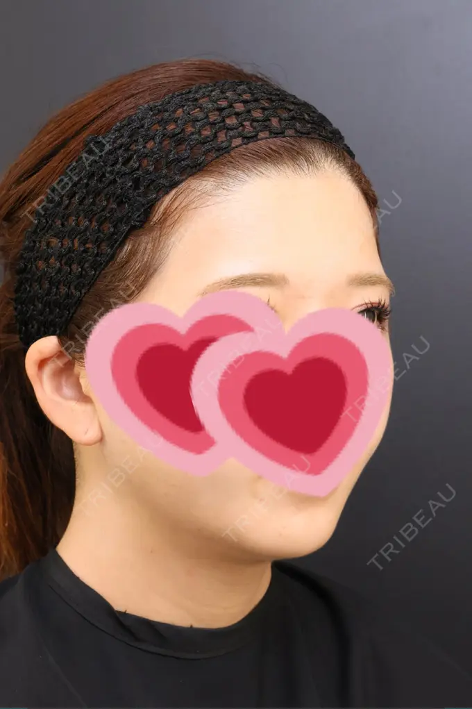 脂肪吸引（顔） / ジョールファット除去 / ボトックス（エラ・小顔） Otus Clinic 【オータスクリニック】 DAY 185 メイン用