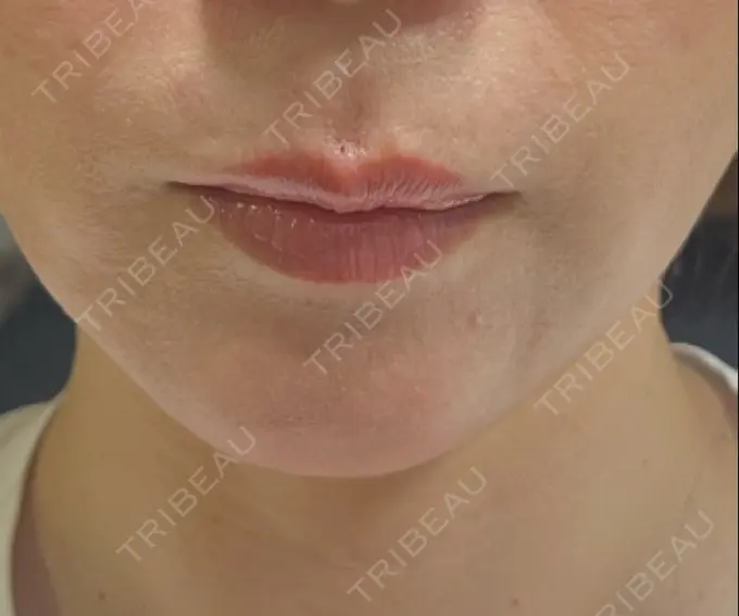 ヒアルロン酸注入（唇） ロレシー美容クリニック 心斎橋駅前院 DAY 1 メイン用