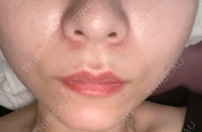 糸リフト 東京シンデレラ美容外科 新宿院 DAY 6 メイン用