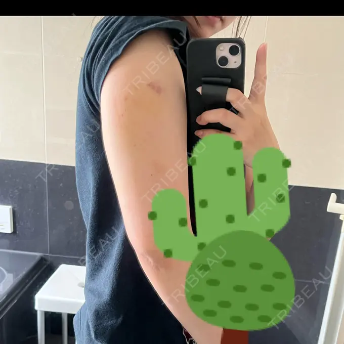 脂肪冷却（二の腕） 湘南美容クリニック 大阪梅田本院 DAY 2 メイン用