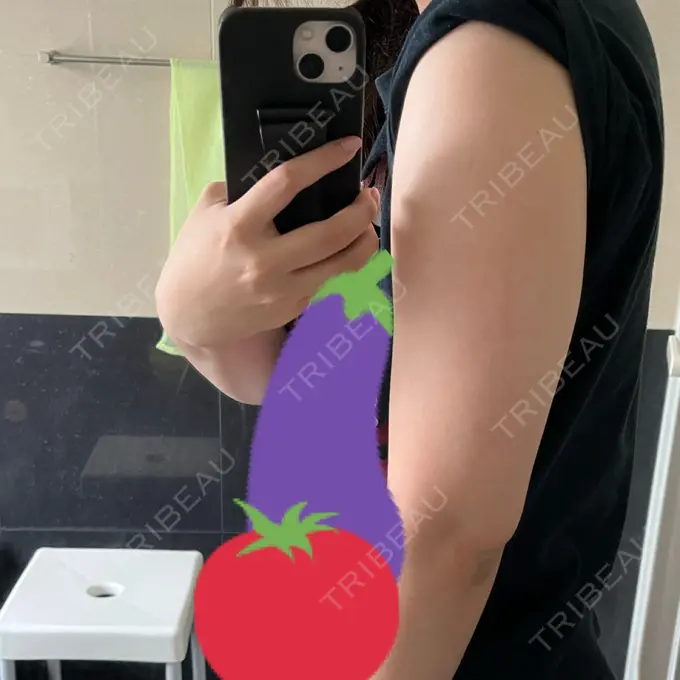 脂肪冷却（二の腕） 湘南美容クリニック 大阪梅田本院 DAY 2 メイン用