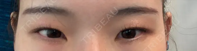 クマ治療 表参道ウィズ・クリニック DAY 8 メイン用