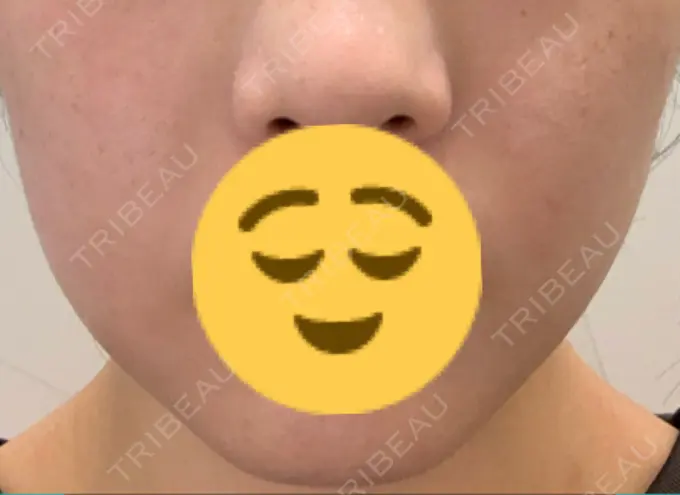 バッカルファット除去 Otus Clinic 【オータスクリニック】 DAY 8 メイン用