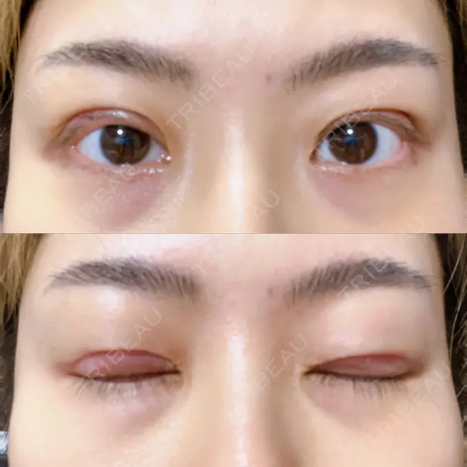 二重切開 みずほクリニック DAY 8 メイン用