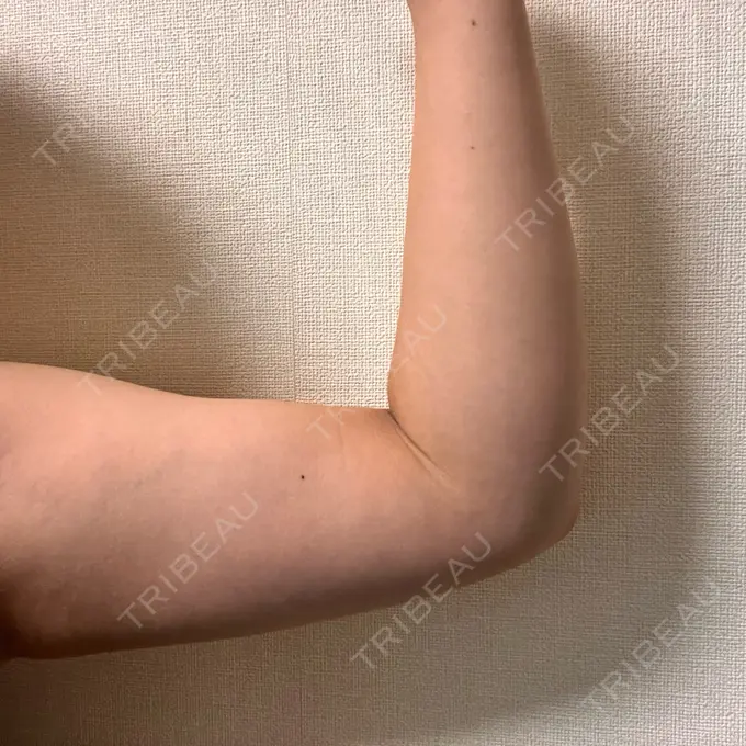 脂肪冷却（二の腕） KOSHOクリニック 本館 DAY 185 メイン用