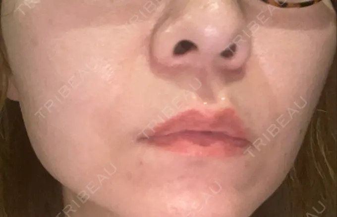 糸リフト 東京シンデレラ美容外科 新宿院 DAY 7 メイン用