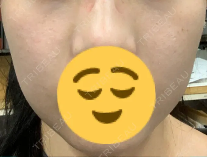 バッカルファット除去 Otus Clinic 【オータスクリニック】 DAY 10 メイン用