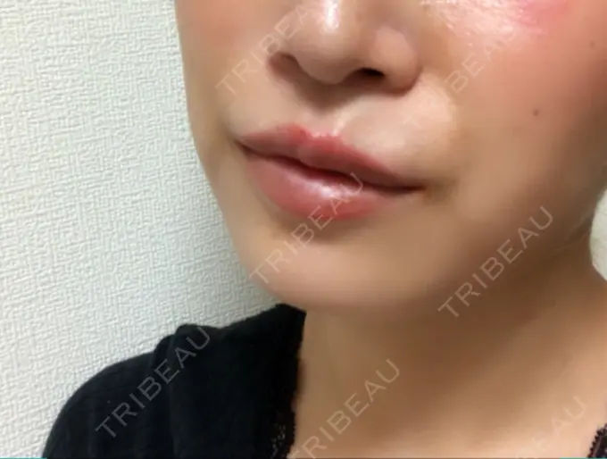 ヒアルロン酸注入（唇） 日本ウェルネス再生クリニック DAY 7 メイン用