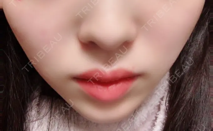 脂肪溶解注射（顔） S Beauty Clinic DAY 49 メイン用