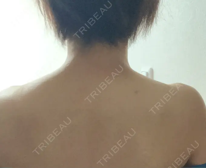 ボトックス（肩） TCB東京中央美容外科 京都駅前院 DAY 7 メイン用