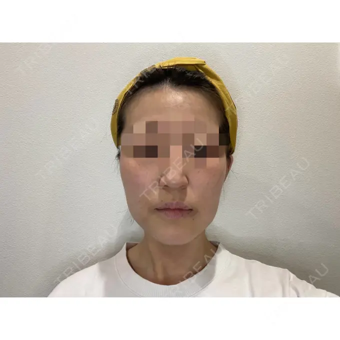 糸リフト / 脂肪吸引（顔） / ジョールファット除去 / ボトックス（エラ・小顔） WOM CLINIC GINZA （ワム クリニック ギンザ） DAY 30 メイン用