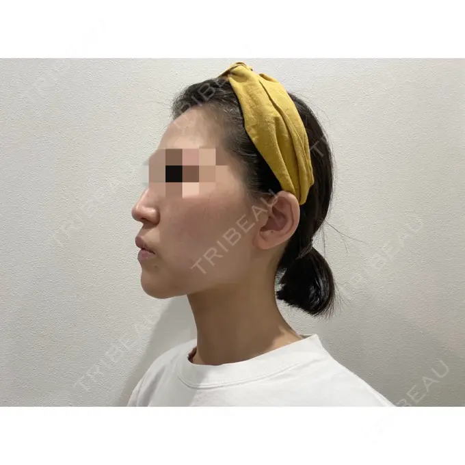 糸リフト / 脂肪吸引（顔） / ジョールファット除去 / ボトックス（エラ・小顔） WOM CLINIC GINZA （ワム クリニック ギンザ） DAY 30 メイン用