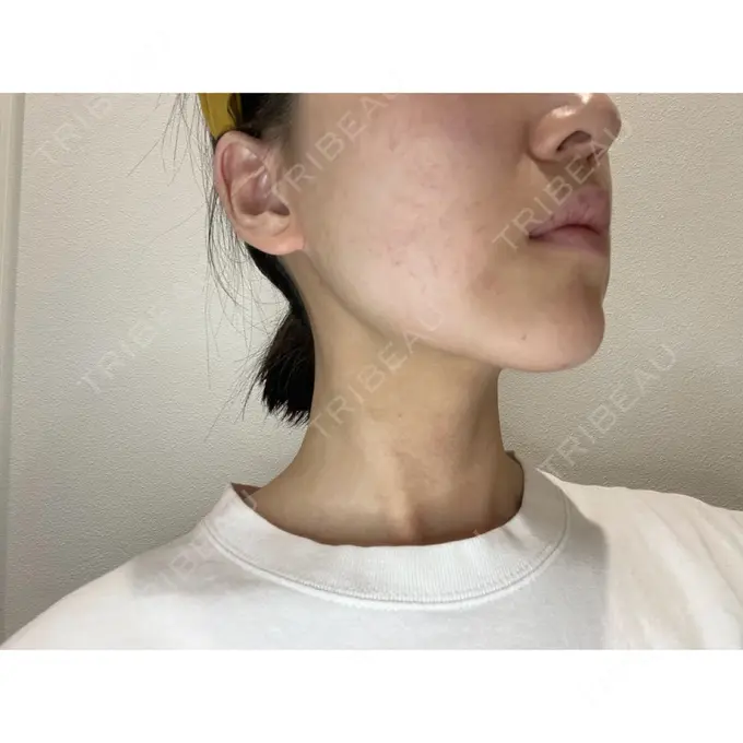 糸リフト / 脂肪吸引（顔） / ジョールファット除去 / ボトックス（エラ・小顔） WOM CLINIC GINZA （ワム クリニック ギンザ） DAY 30 メイン用