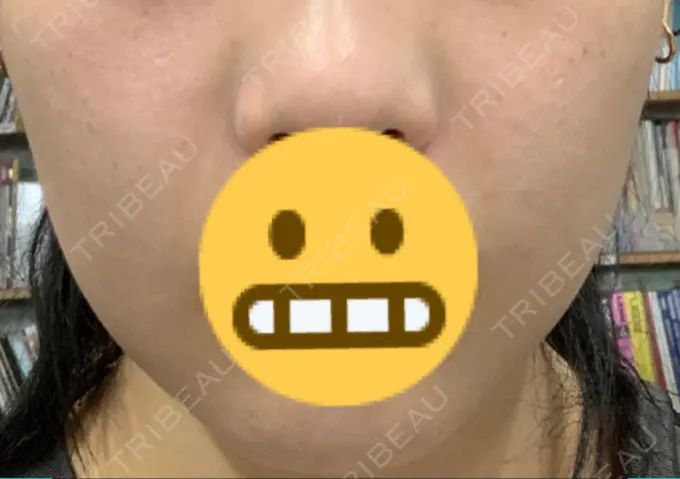 バッカルファット除去 Otus Clinic 【オータスクリニック】 DAY 11 メイン用