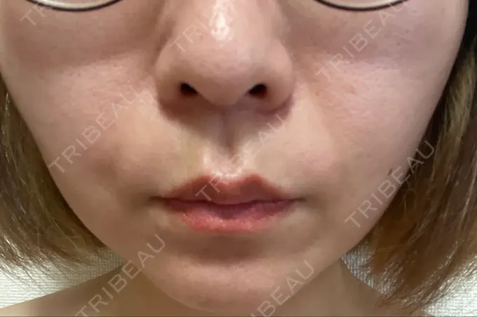 糸リフト 東京シンデレラ美容外科 新宿院 AFTER メイン用