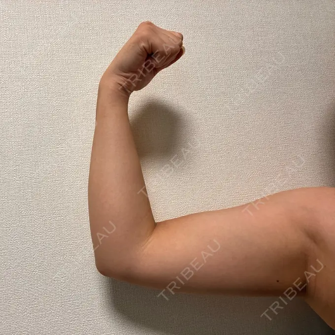 脂肪冷却（二の腕） KOSHOクリニック 本館 DAY 199 メイン用