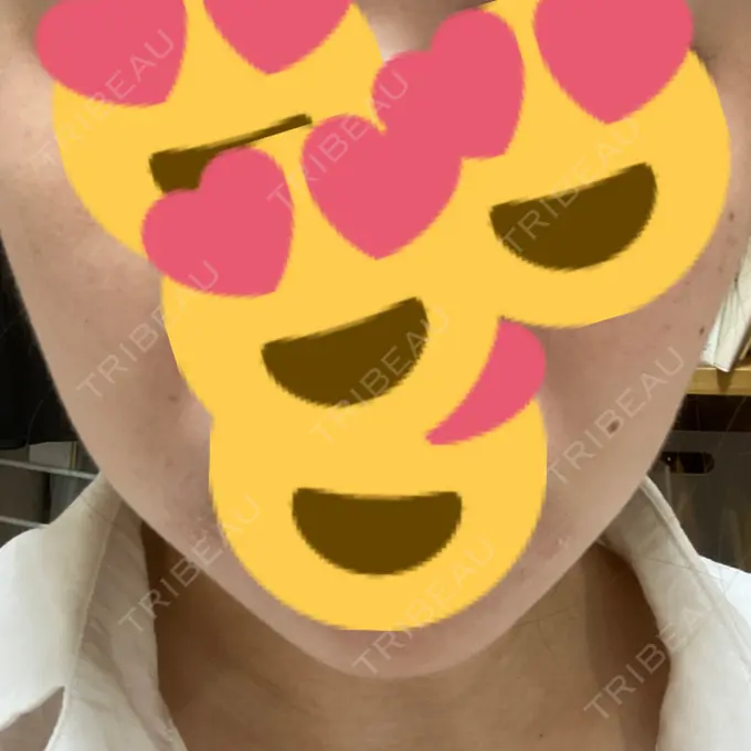 脂肪溶解注射（顔） 表参道ウィズ・クリニック DAY 6 メイン用