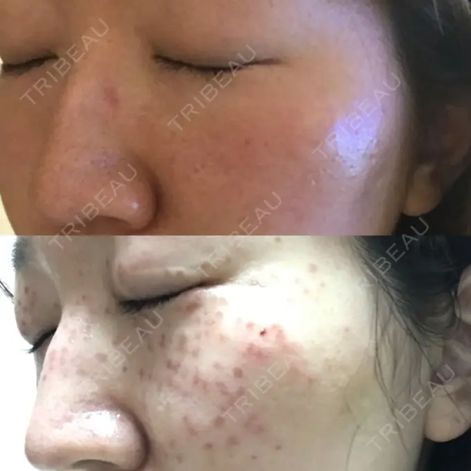 美肌レーザー / シミ取りレーザー / ルビーレーザー 銀座お肌の診療所 DAY 32 メイン用