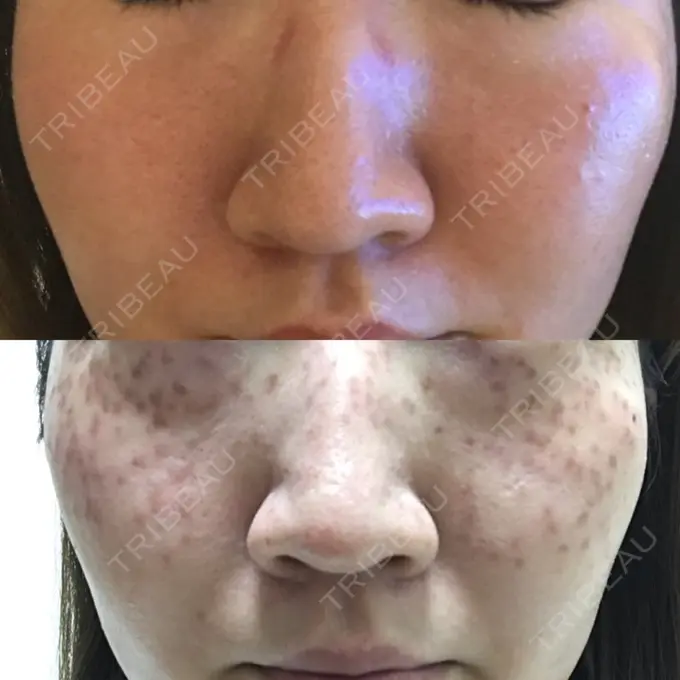 美肌レーザー / シミ取りレーザー / ルビーレーザー 銀座お肌の診療所 DAY 32 メイン用