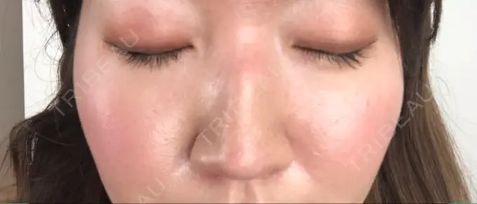 美肌レーザー / シミ取りレーザー / ルビーレーザー 銀座お肌の診療所 AFTER メイン用