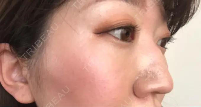 美肌レーザー / シミ取りレーザー / ルビーレーザー 銀座お肌の診療所 DAY 32 メイン用