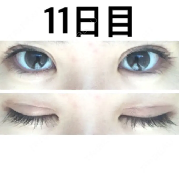 二重切開 みずほクリニック DAY 11 メイン用