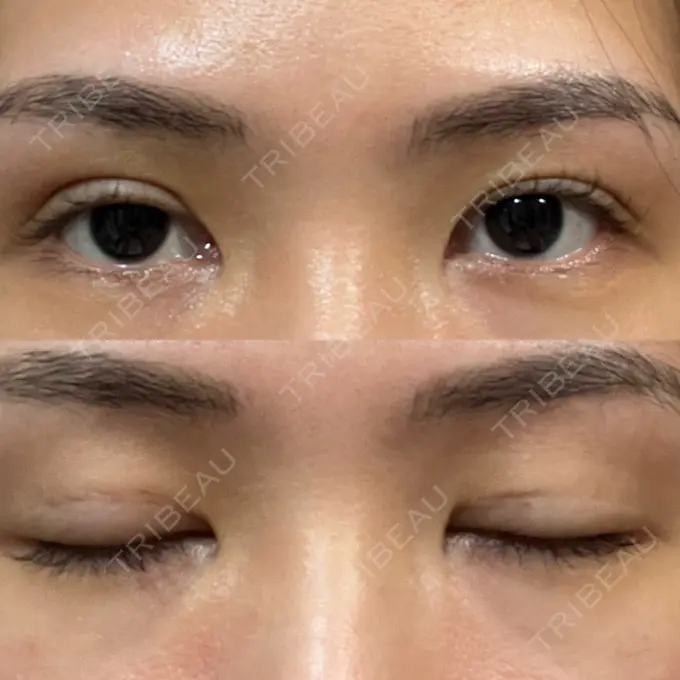 二重埋没 大塚美容形成外科 銀座本院 DAY 3 メイン用